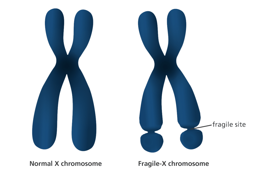 Fragile x syndrome что это